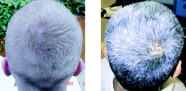 File:Hair whorl direction.jpg