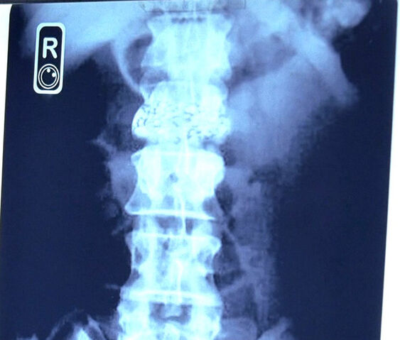 Ficheiro:Xray.jpg