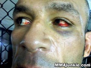 Medium mostapha-al-turk-picture-injured-eye-big