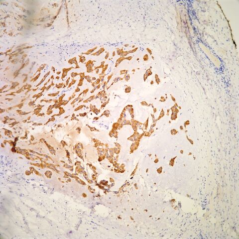 File:AE1.3.myoepithelioma.parachordoma.2.jpg