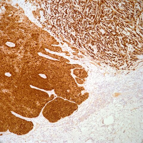 File:P16.squamous cell carcinoma.1.jpg