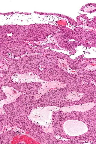 File:400px-Inverted papilloma high mag.jpg