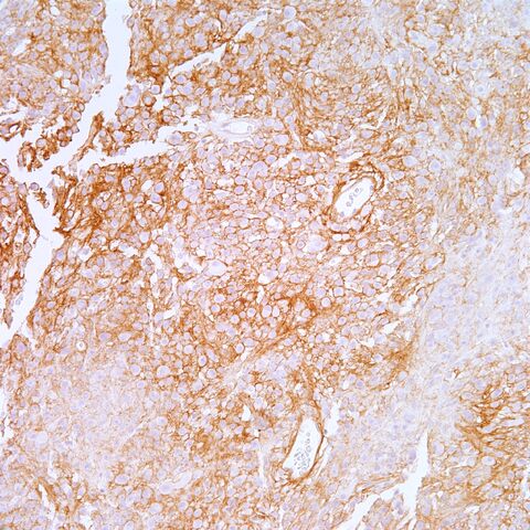 File:Type IV collagen.epithelioid schwannoma.1.jpg