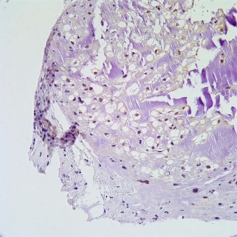 File:Brachyury.chordoma.5.jpg