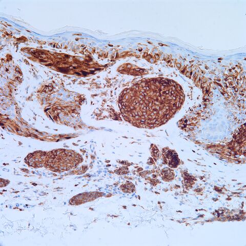 File:NKI-C3.melanoma.m.3.jpg