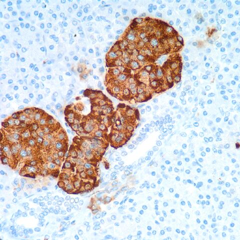 File:Chromogranin.met neuroendocrine carcinoma in liver.400x.2.jpg