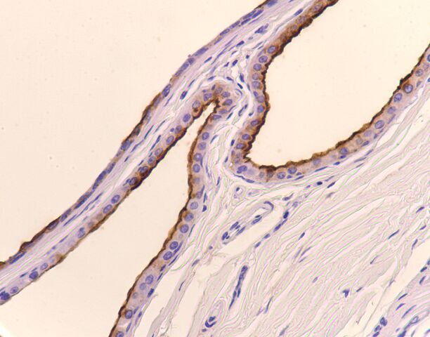 File:EMA.breast.apocrine metaplasia.400x.jpg
