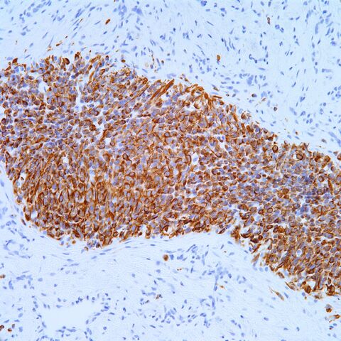 File:Desmin.alveolar rhabdomyosarcoma.1.jpg