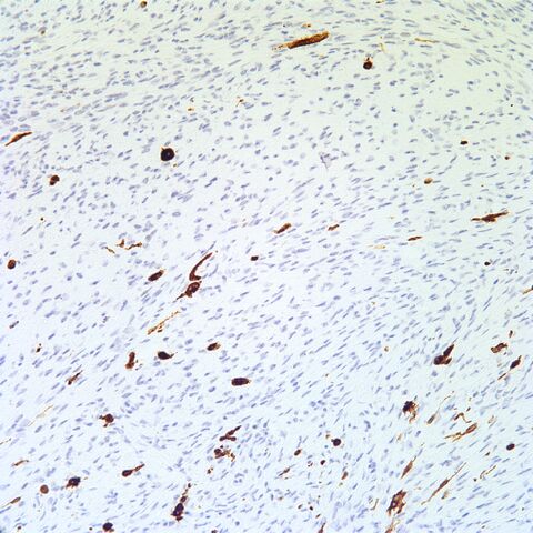 File:Tyrosinase.pigmented neurofibroma.1.jpg