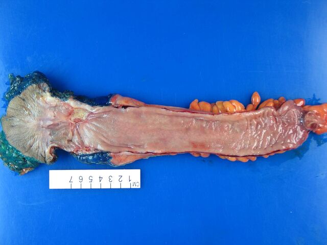 File:Rectum opened.jpg