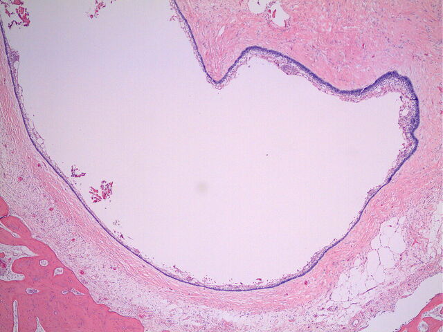 File:Ameloblastoma intraosseous follicular.jpg