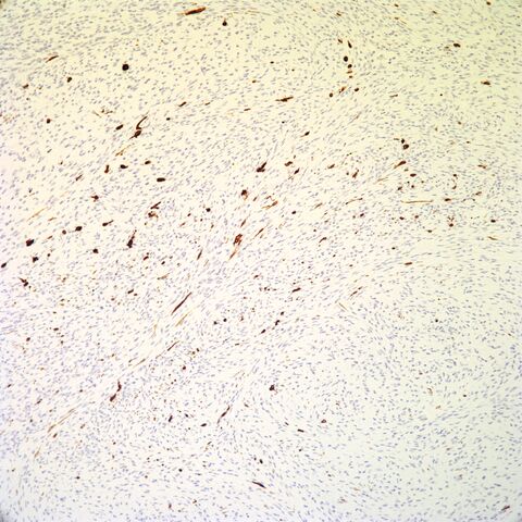 File:Tyrosinase.pigmented neurofibroma.2.jpg