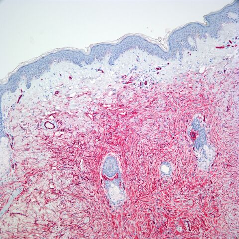 File:CD34.DFSP.red.3.jpg
