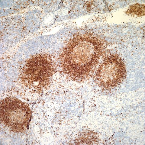 File:CD79a.lymph node.3.jpg