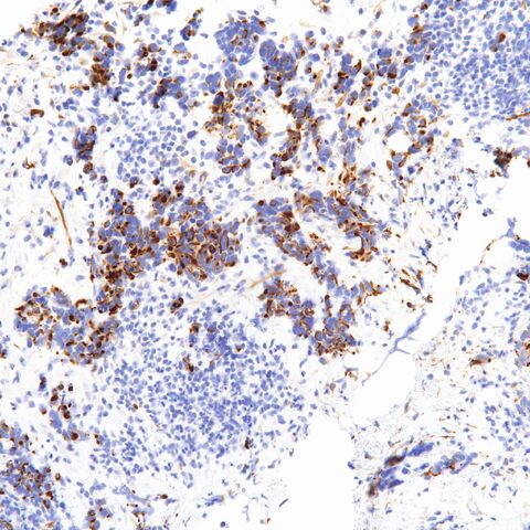 File:Desmin.DSRCT.desmoplastic small round cell tumor.1.jpg