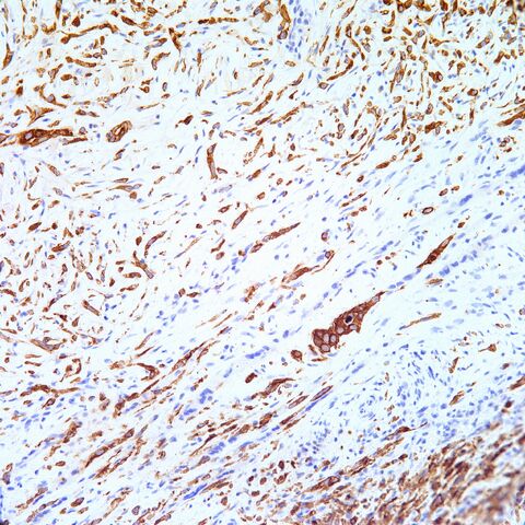 File:AE1-3.cytokeratin.mesothelioma.3.jpg