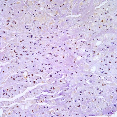File:Brachyury.chordoma.7.jpg