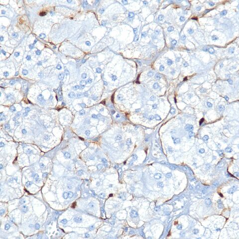 File:S100.paraganglioma.sustentacular.2.jpg