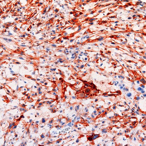 File:CD10.sarcomatoid scc.200x.2.jpg