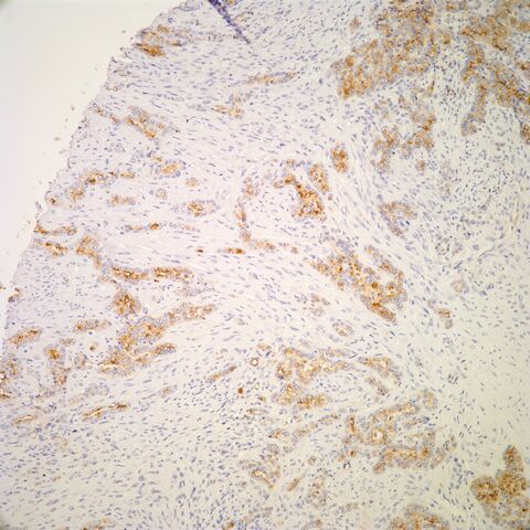 File:HBME-1.mesothelioma.1.jpg