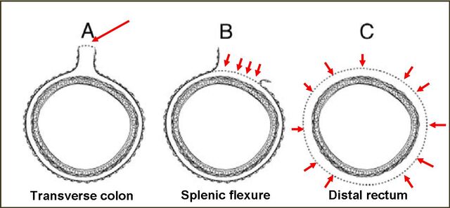 File:Rectum radial margins.jpg
