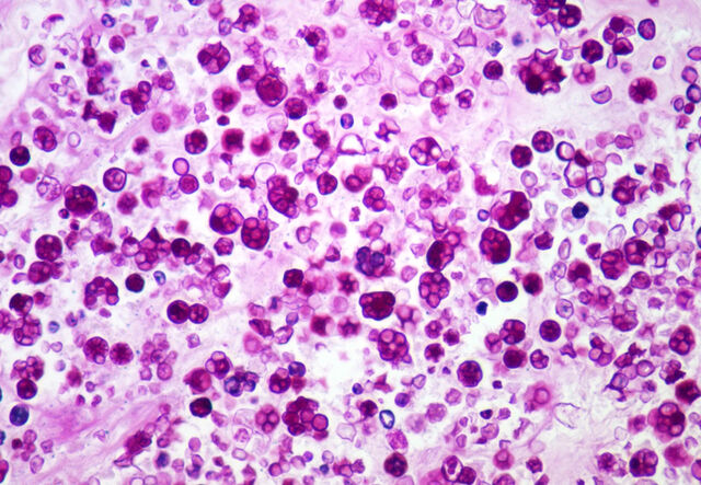 File:Protothecosis edited.jpg