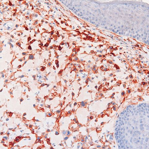 File:CD10.sarcomatoid scc.200x.1.jpg