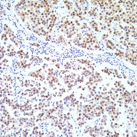 File:OCT.3-4.seminoma.2.jpg