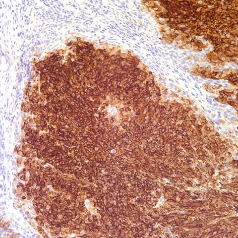File:HMB-45.melanoma.1.jpg