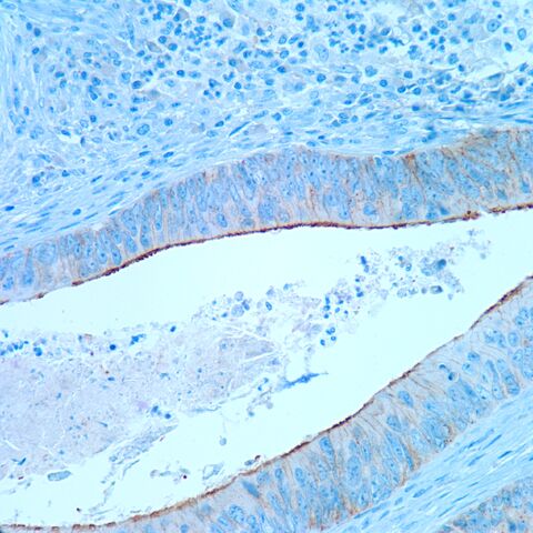 File:Villin.colonic adenoca.1.jpg