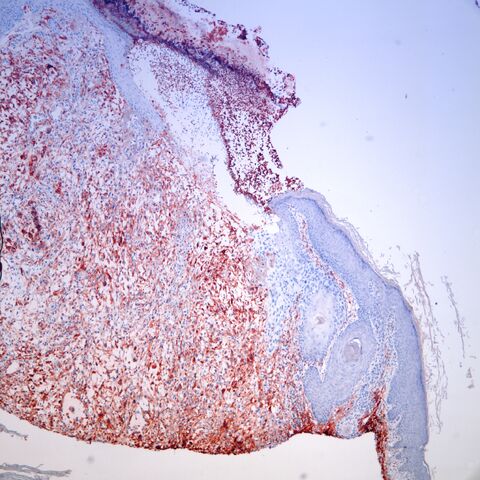 File:CD10.sarcomatoid scc.40x.jpg