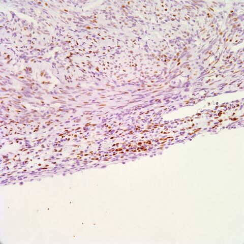 File:ER.AML with cyst.2.jpg
