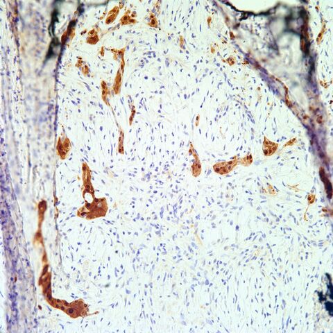 File:Calretinin.mesothelioma.jpg