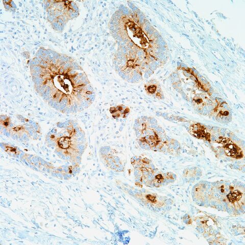 File:B72.3.colonic adenoca.1.jpg
