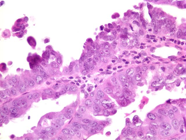File:Uterine Serous Carcinoma4.jpg
