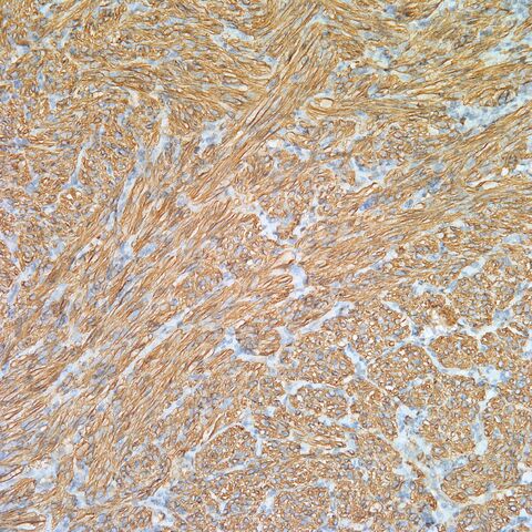 File:SMA.AML with cyst.1.jpg
