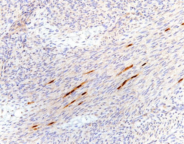 File:Myogenin.entrapped skeletal muscle.200x.2.jpg