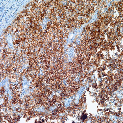 File:PLAP.seminoma.3.jpg