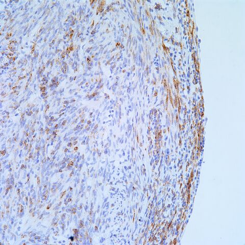 File:Hmb45.AML with cyst.3.jpg