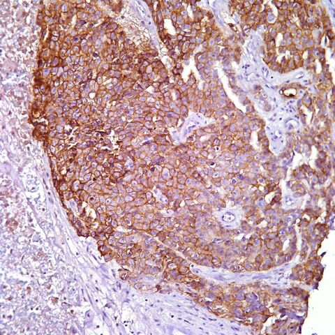 File:CD30.embryonal carcinoma.jpg
