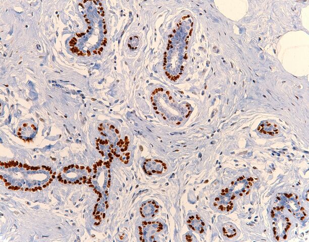 File:P63.breast.200x.jpg