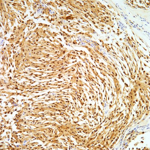 File:MiTF.cellular neurothekeoma.2.jpg