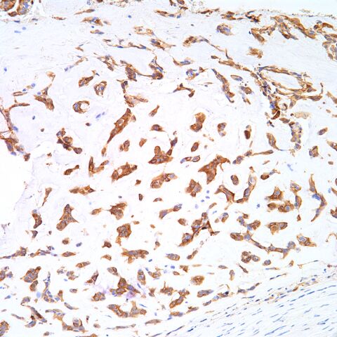 File:AE1.3.myoepithelioma.parachordoma.1.jpg
