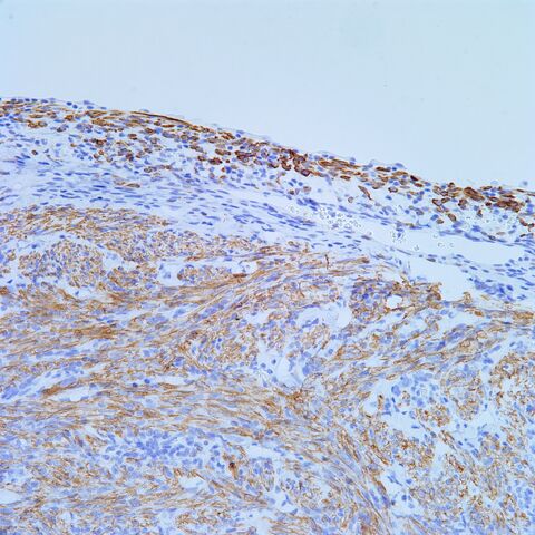 File:Desmin.AML with cyst.2.jpg
