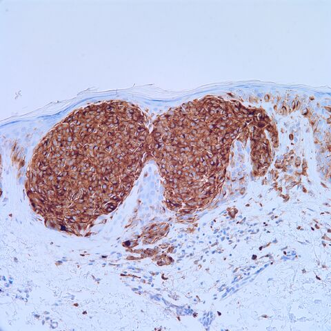 File:NKI-C3.melanoma.m.2.jpg