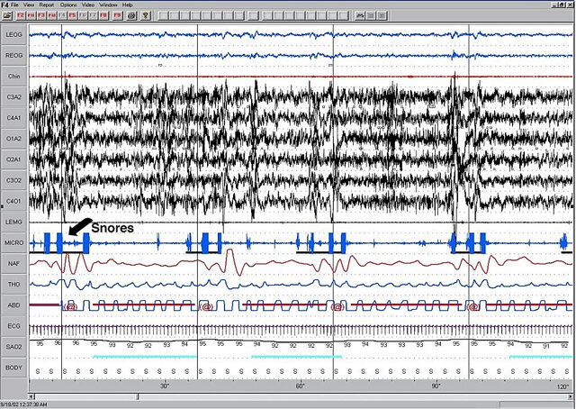 File:Apnea2Min.jpg