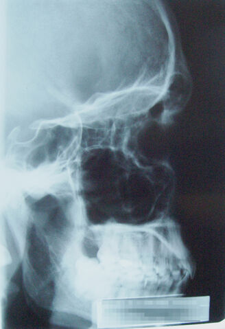 File:X-Ray Skull.jpg