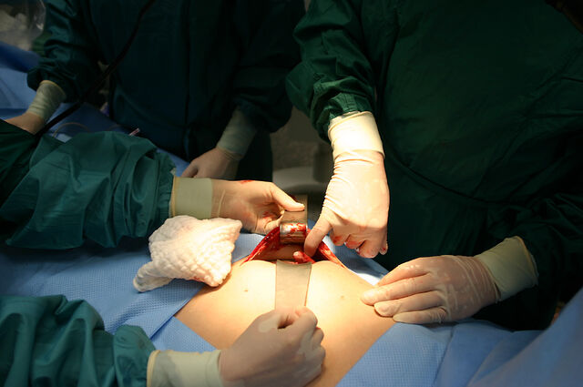 File:Blinddarm-01.jpg