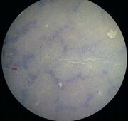 Myeloid leukemia. Leukocytes in the liver