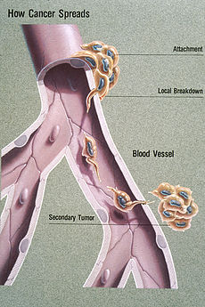 File:Metastasis.jpg